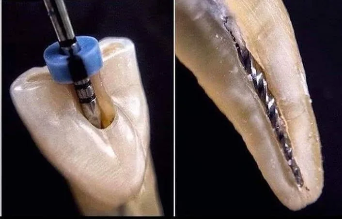 Endodontics treatment at DentiQ