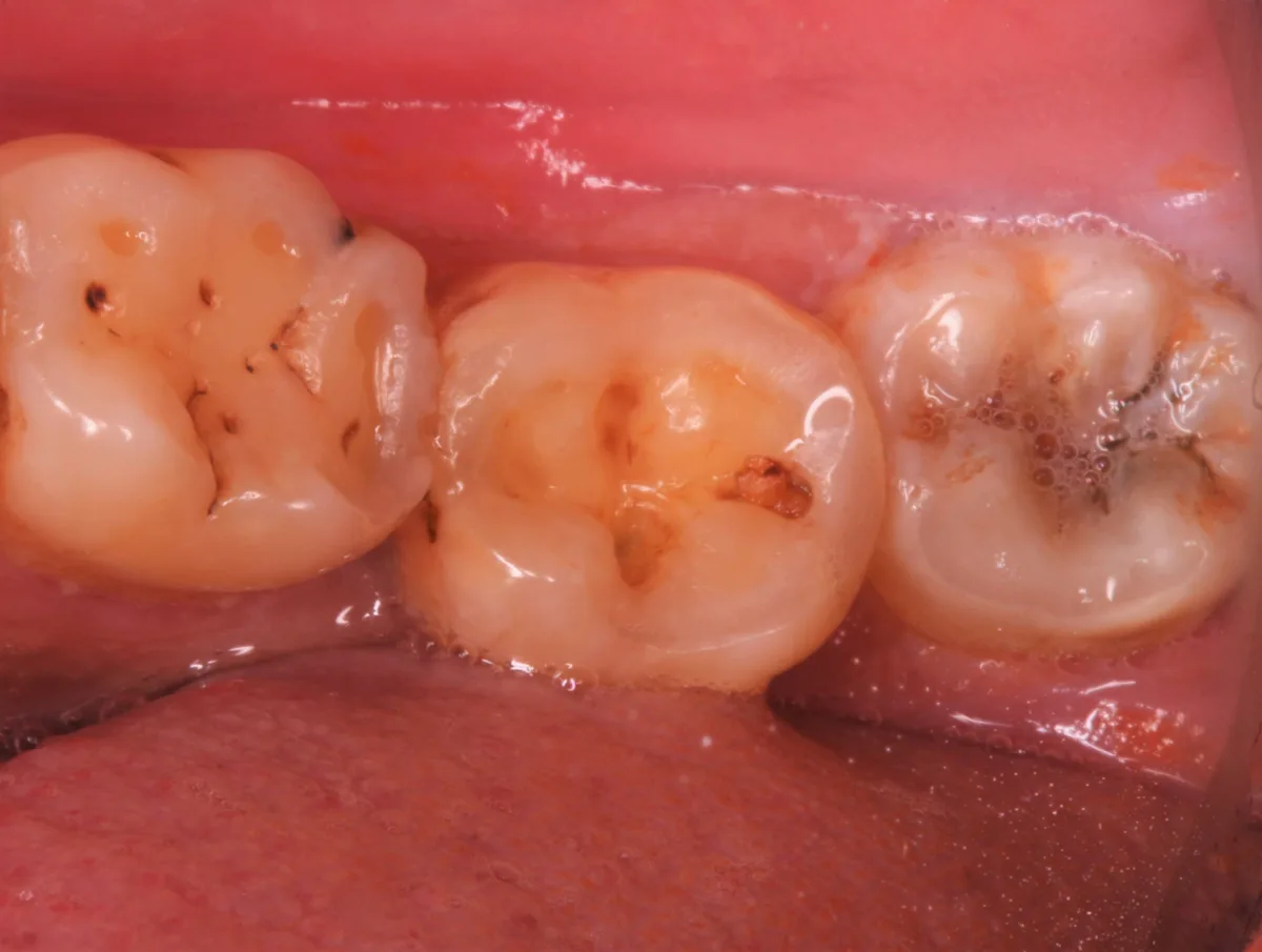 Back Tooth Restoration