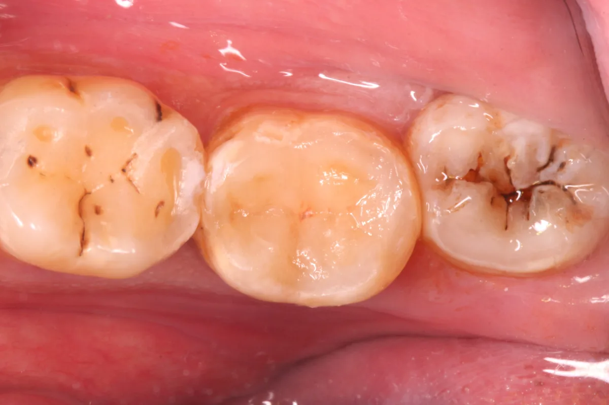 After — Back Tooth Restoration