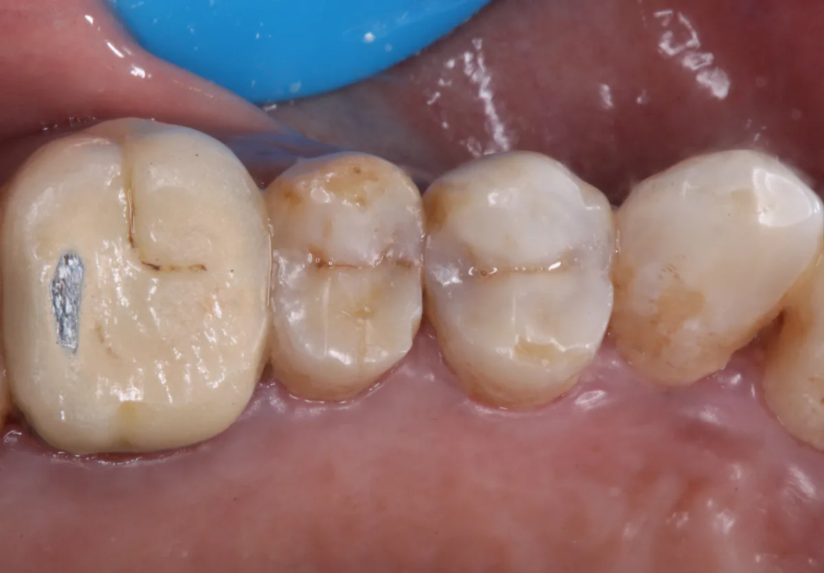 Back Tooth Restoration