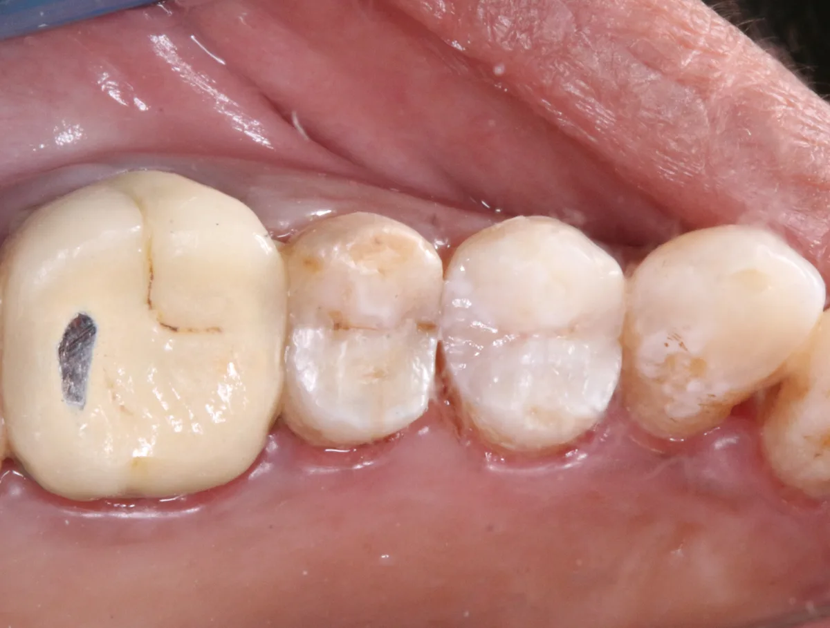 After — Back Tooth Restoration