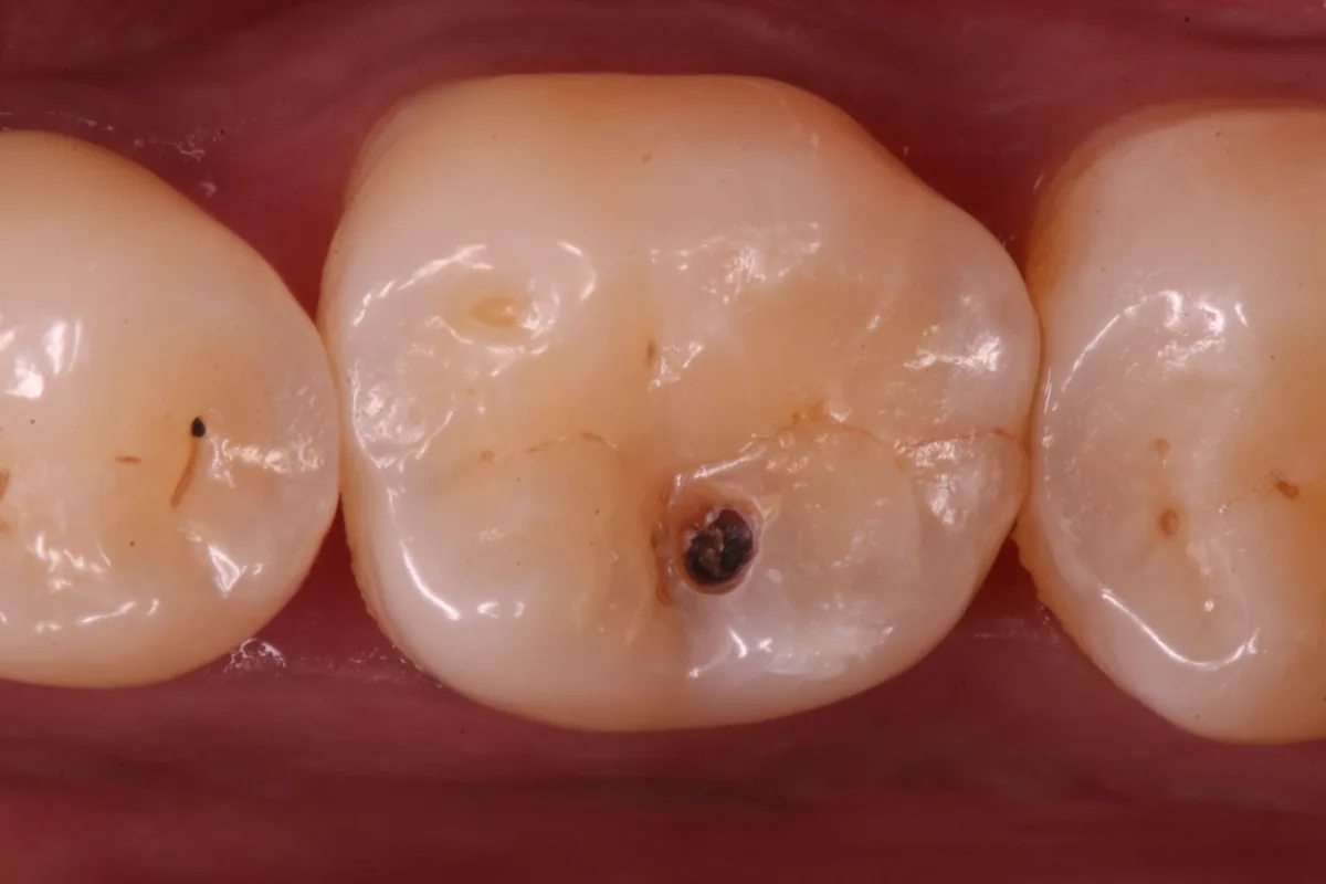 Back Tooth Restoration
