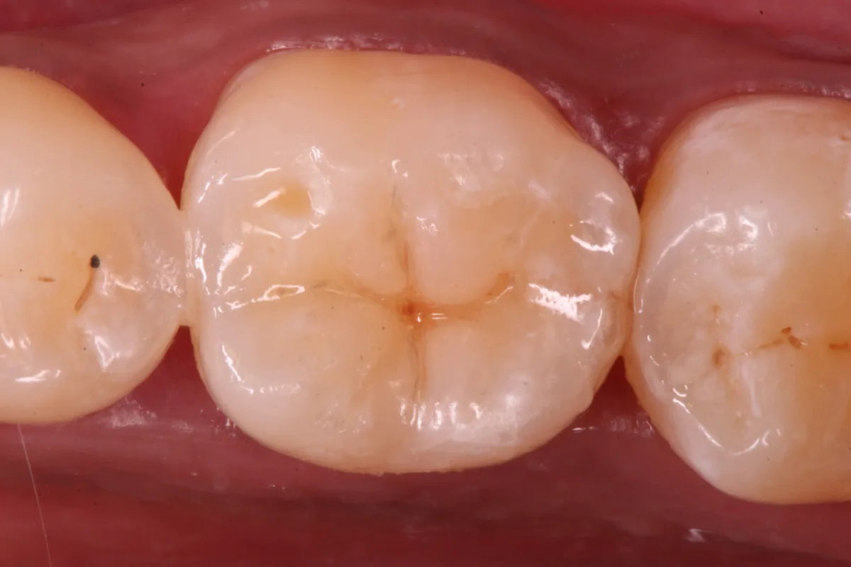 After — Back Tooth Restoration
