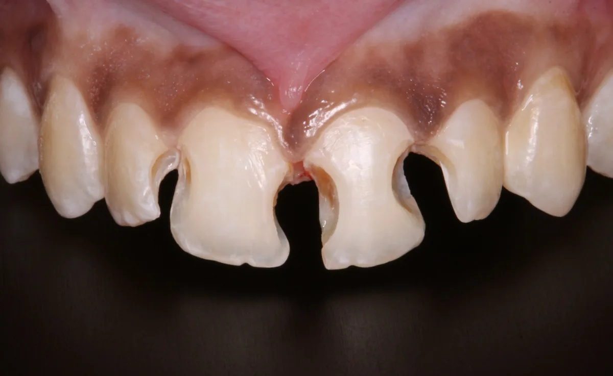 Front Teeth Restoration