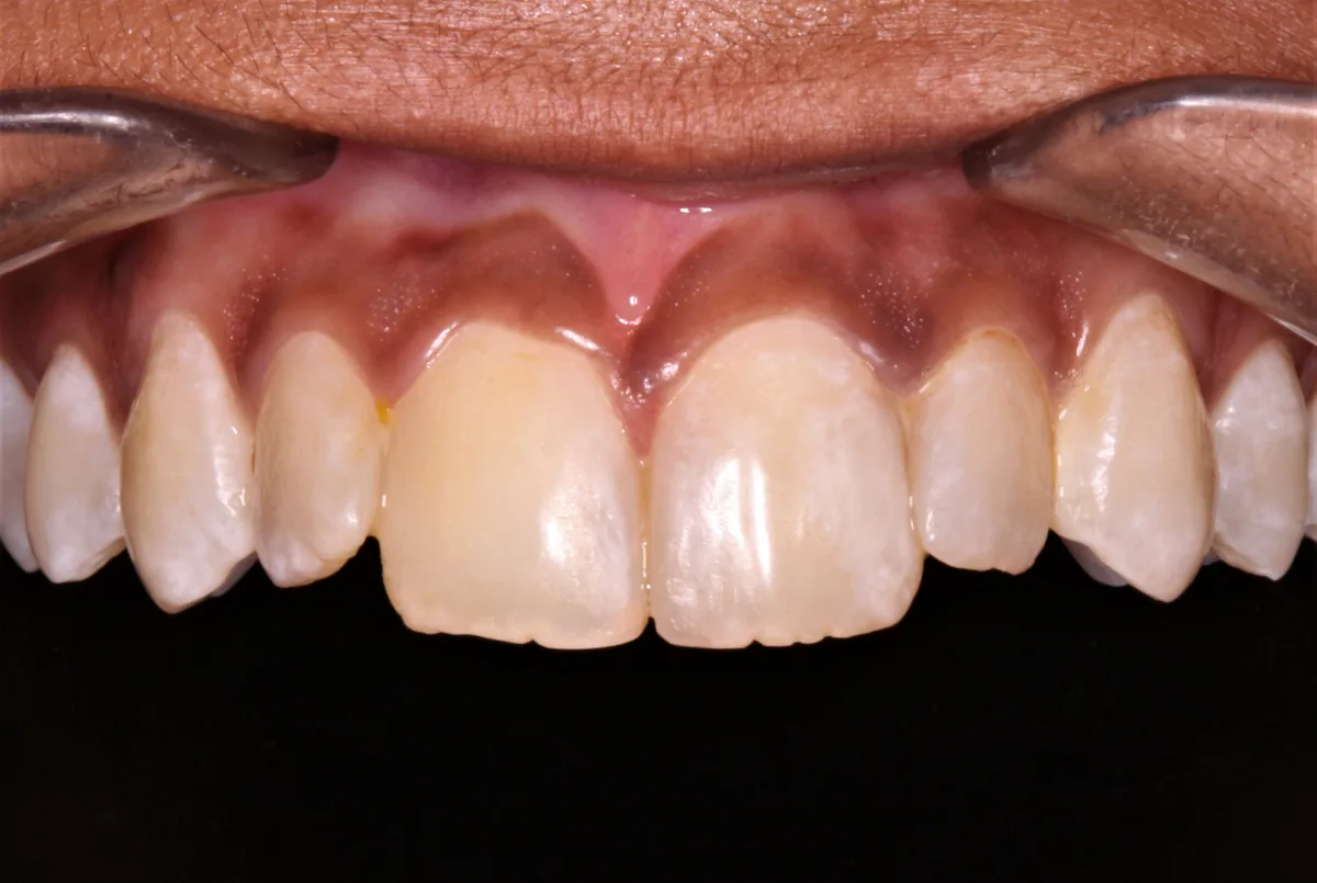 After — Front Teeth Restoration