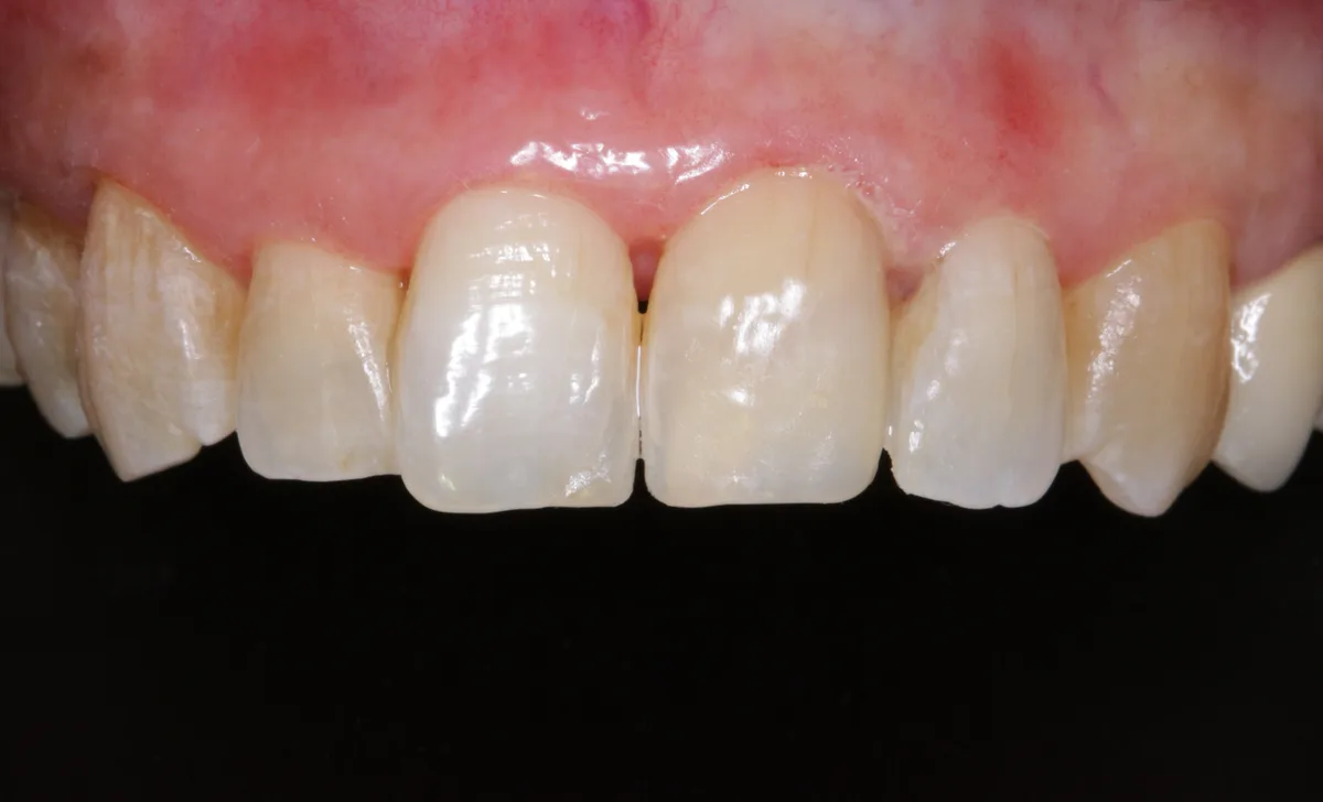 After — Front Teeth Restoration