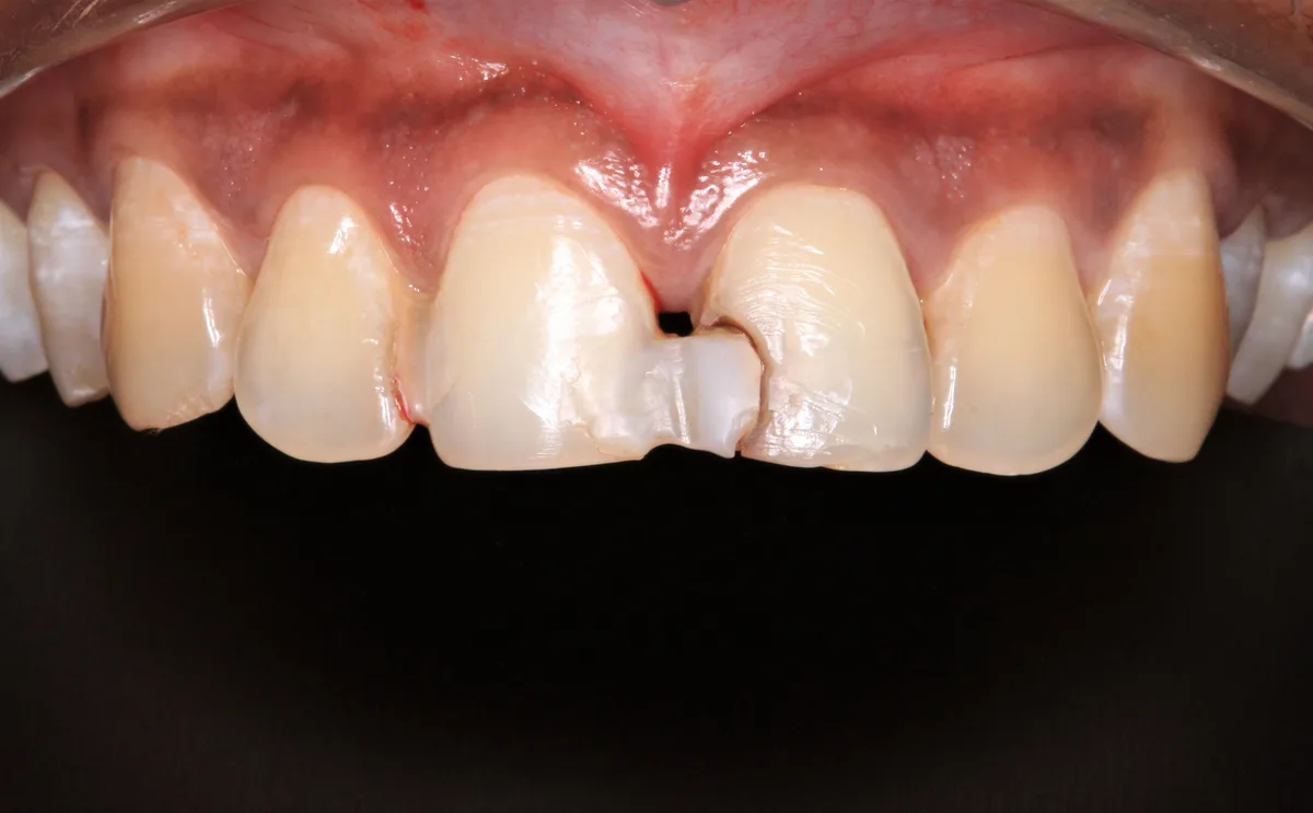 Front Teeth Restoration