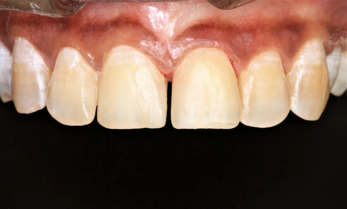 After — Front Teeth Restoration