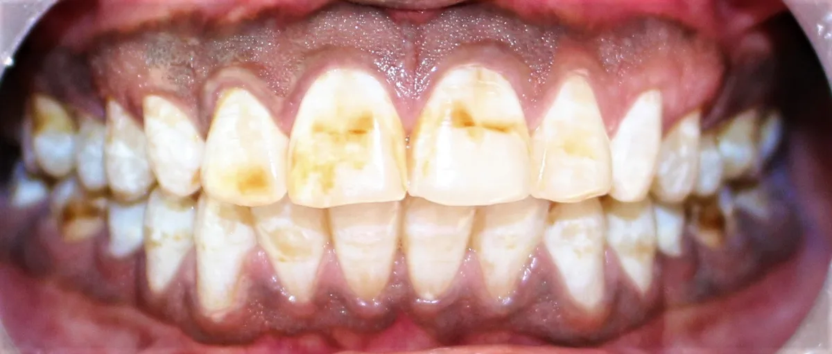 Teeth Whitening