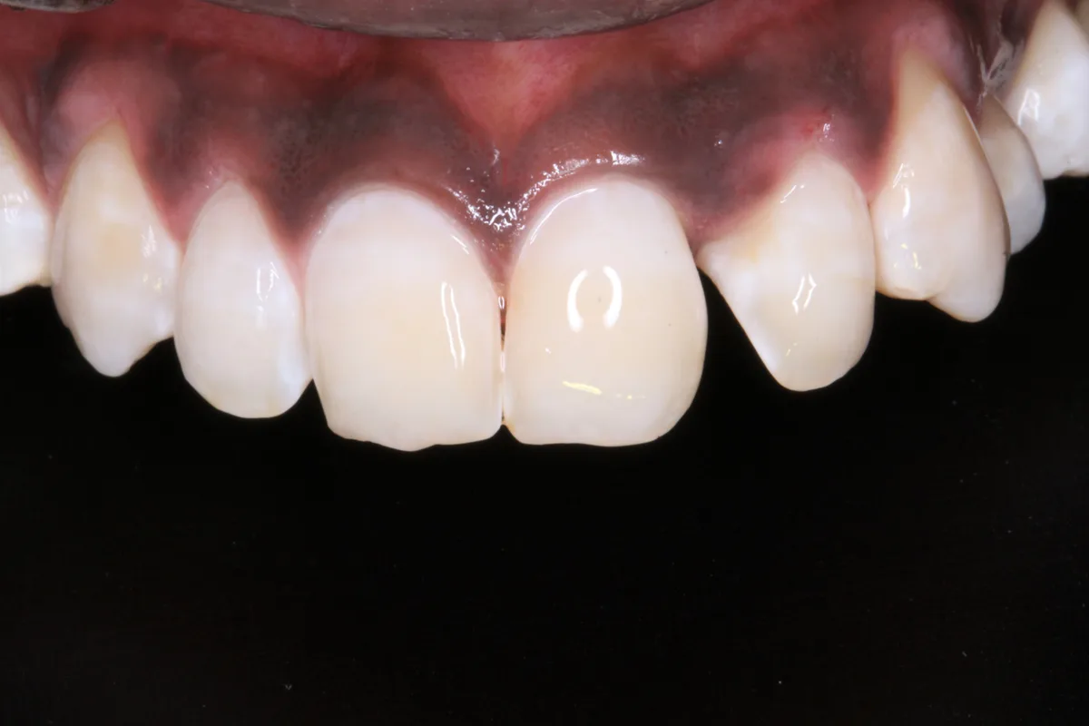 After — Teeth Whitening