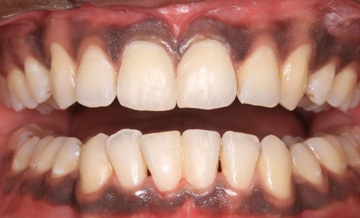 After — Midline Gap Closure