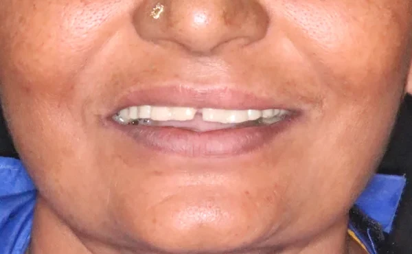Smile Makeover