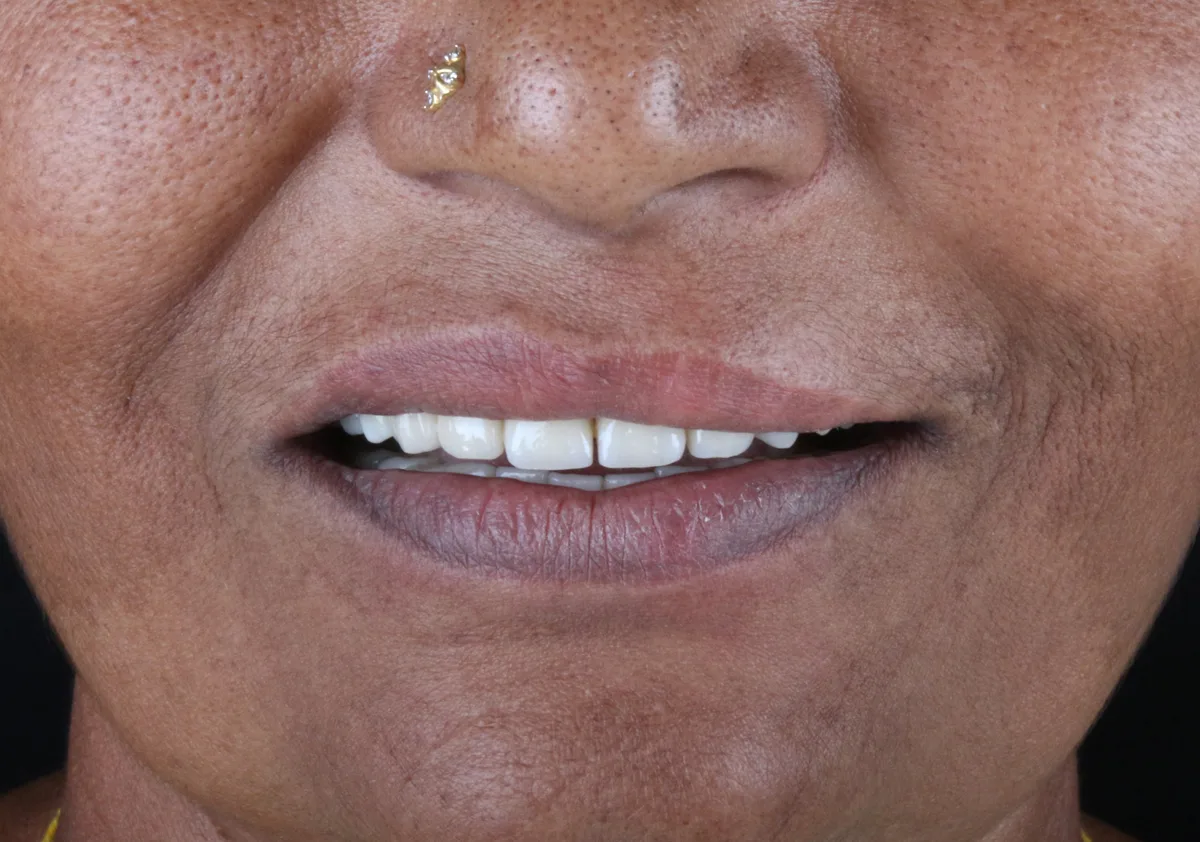 After — Smile Makeover