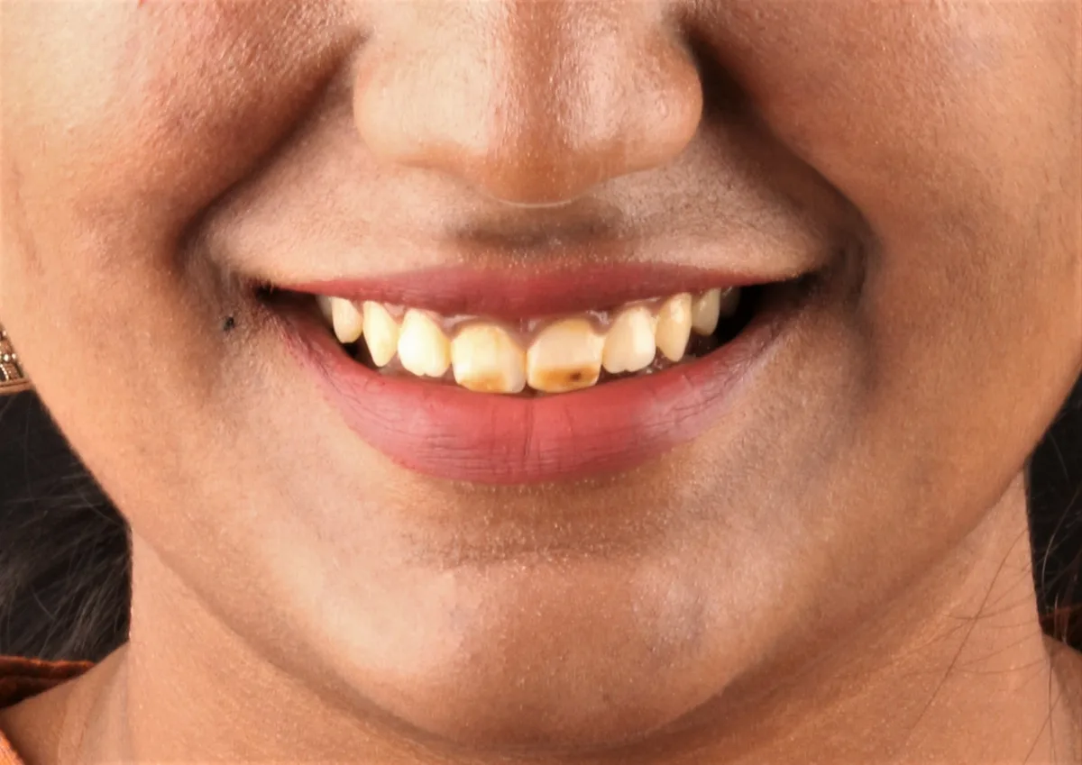 Smile Makeover