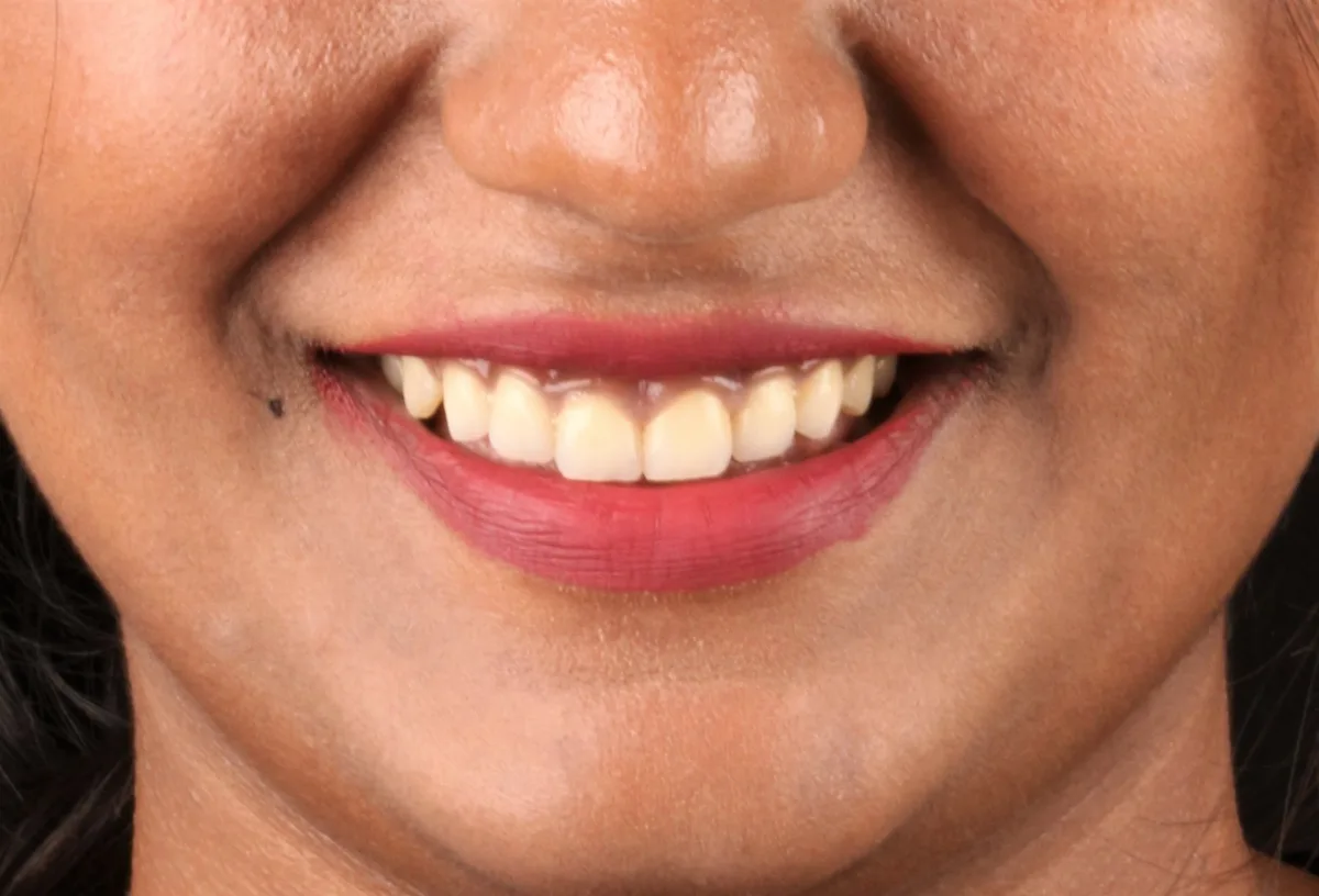 After — Smile Makeover
