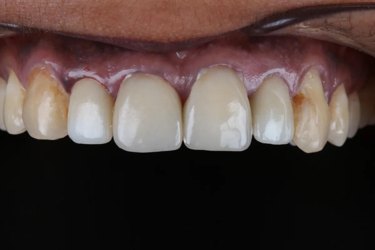 Smile Makeover