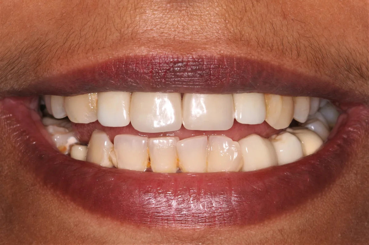 Smile Makeover