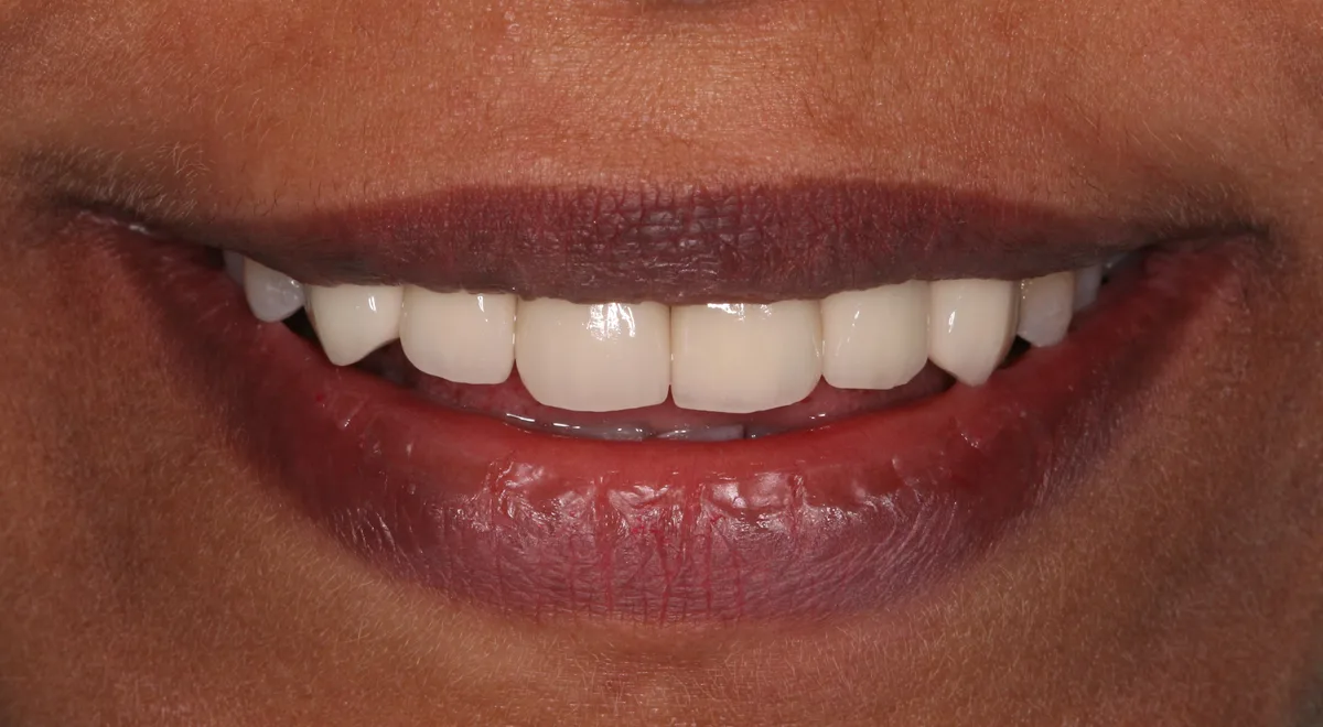 After — Smile Makeover