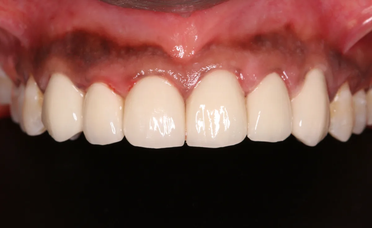 After — Smile Makeover