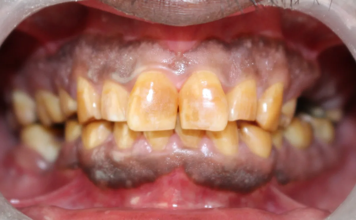 Smile Makeover