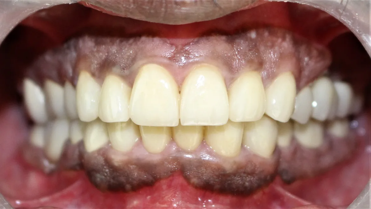 After — Smile Makeover