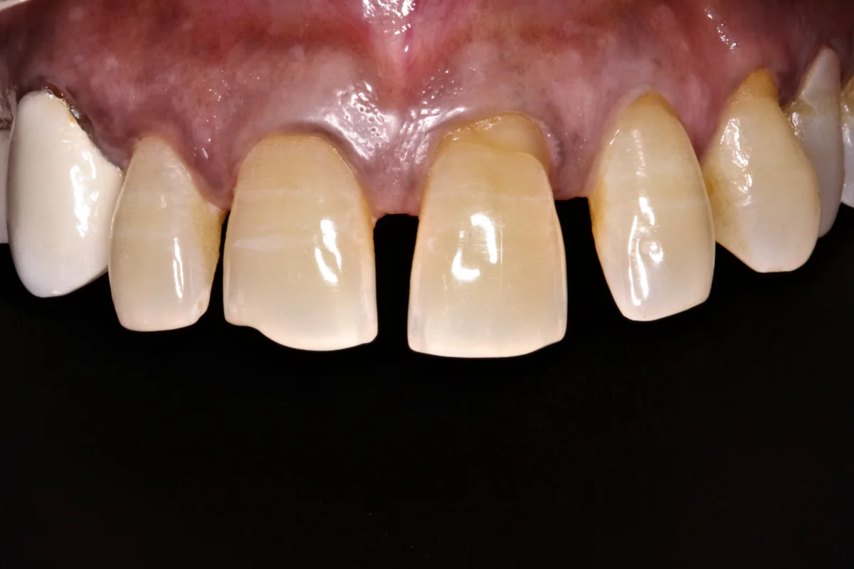 Tooth Size & Shape