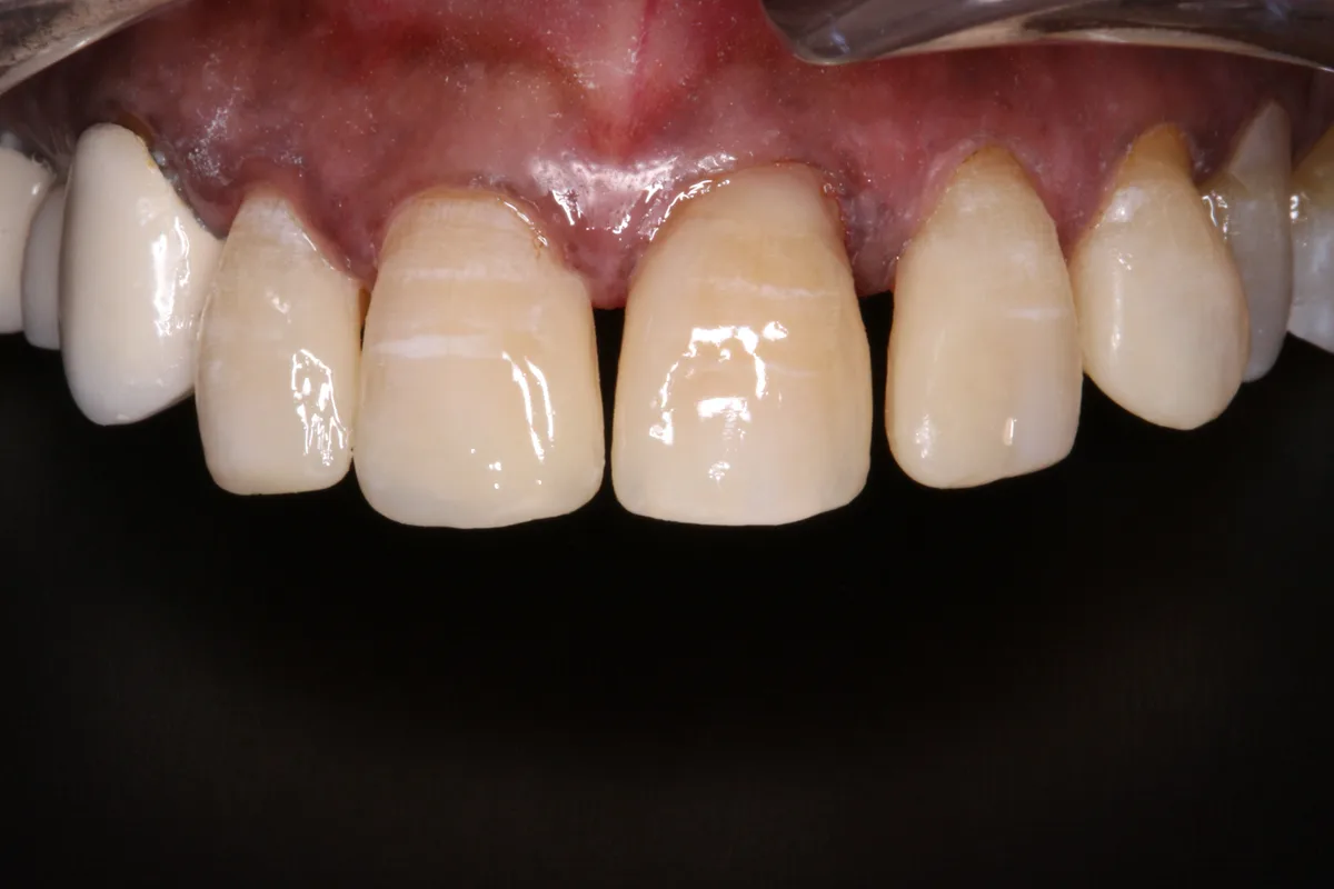 After — Tooth Size & Shape