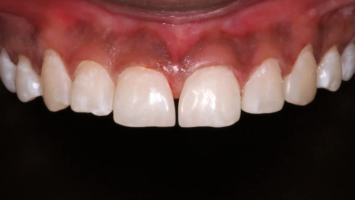 After — Tooth Size & Shape