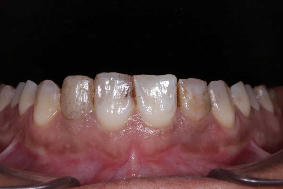 Porcelain Veneers