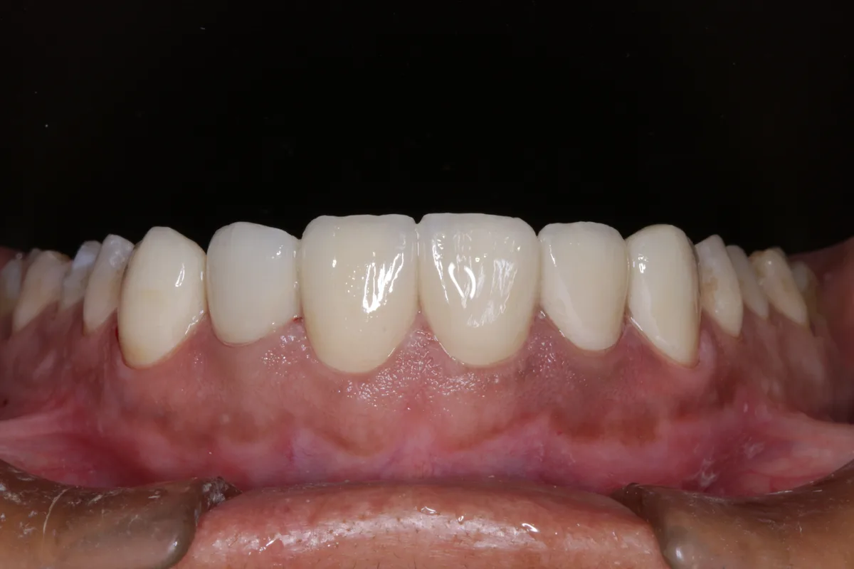 After — Porcelain Veneers