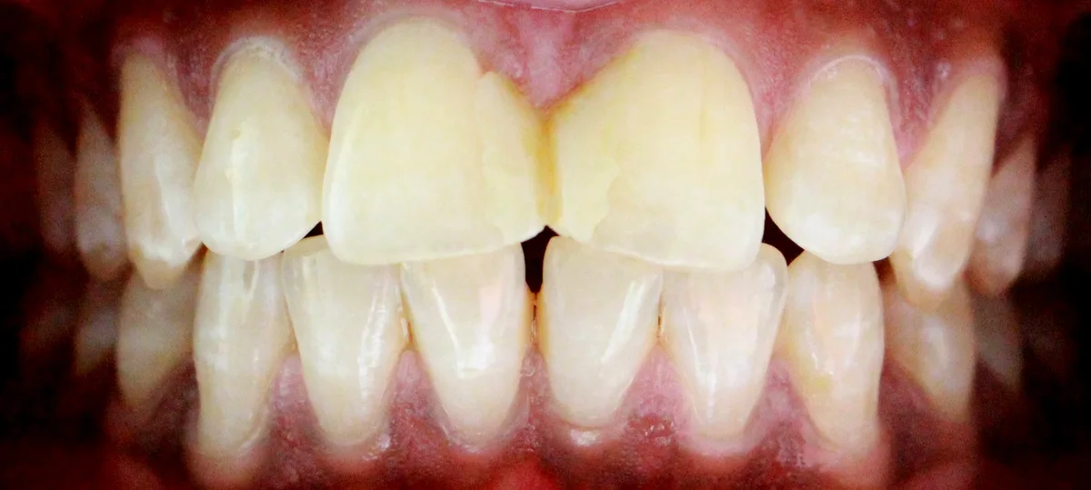 Porcelain Veneers