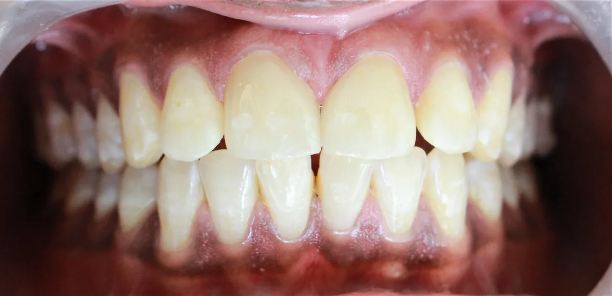 After — Porcelain Veneers