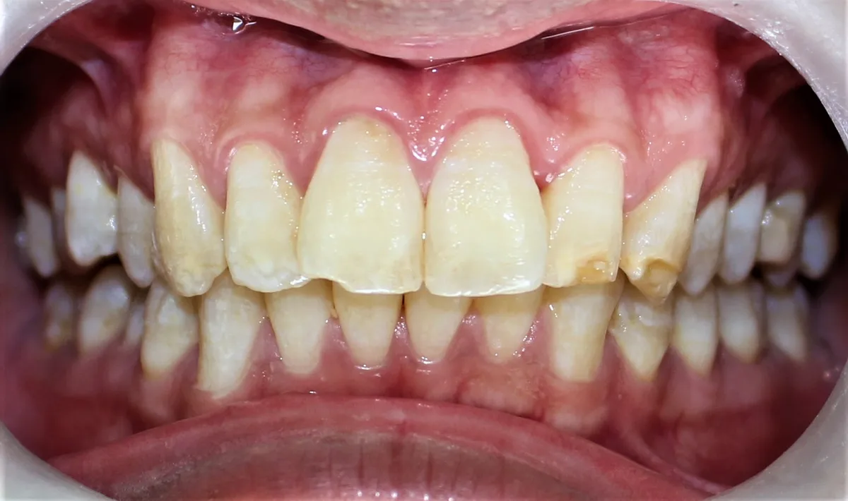 Porcelain Veneers