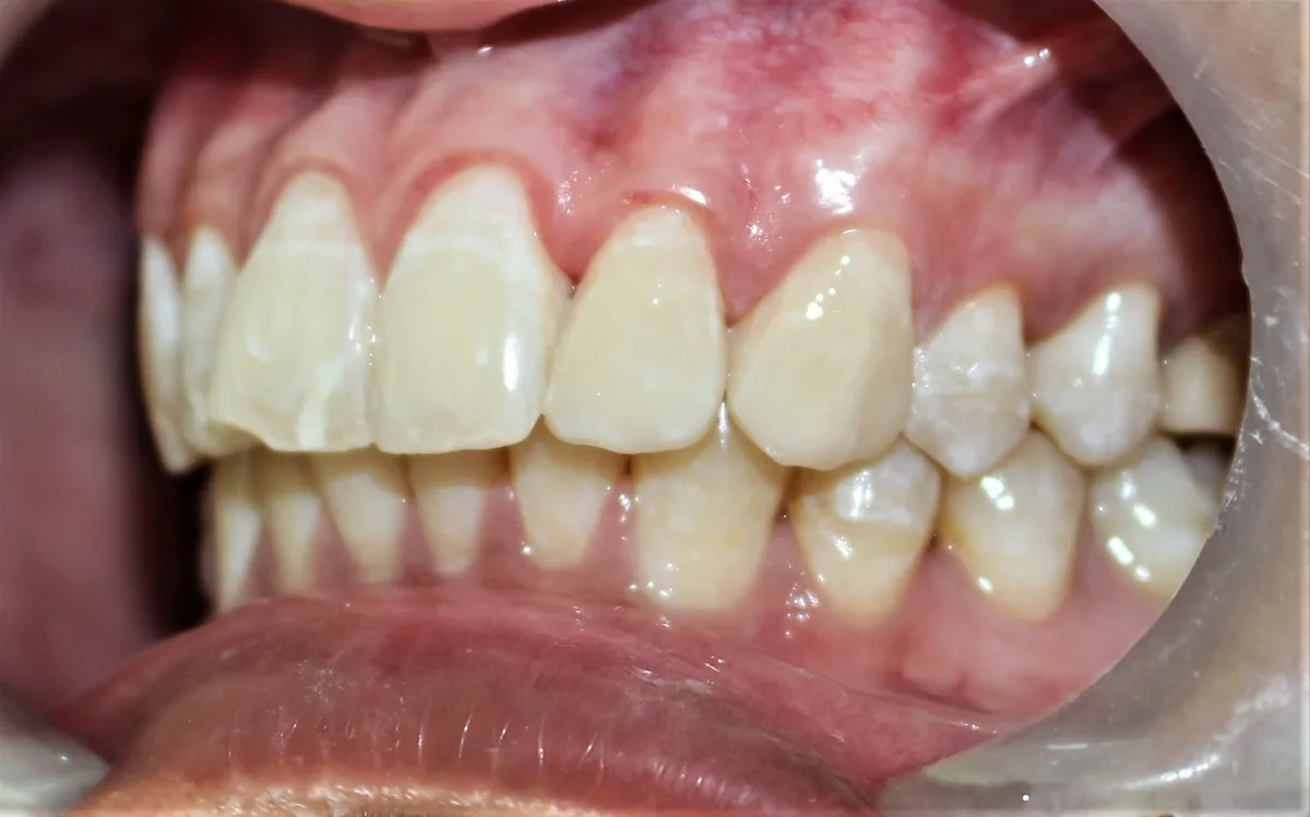 After — Porcelain Veneers