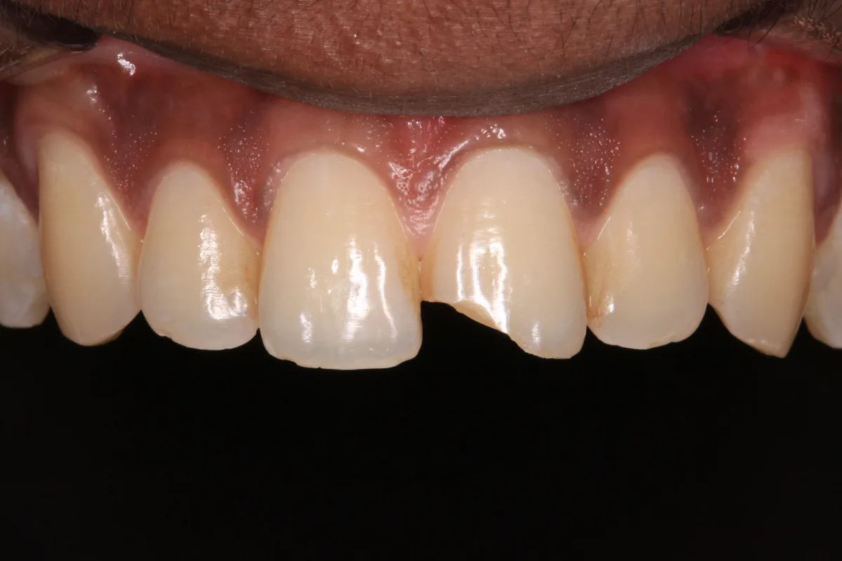 Porcelain Veneers