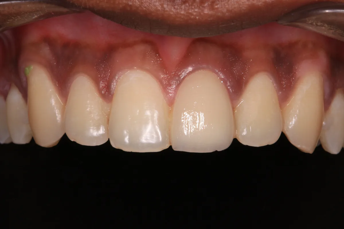 After — Porcelain Veneers
