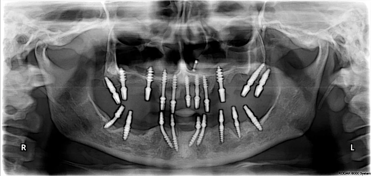 Basal Implants — Immediate Loading