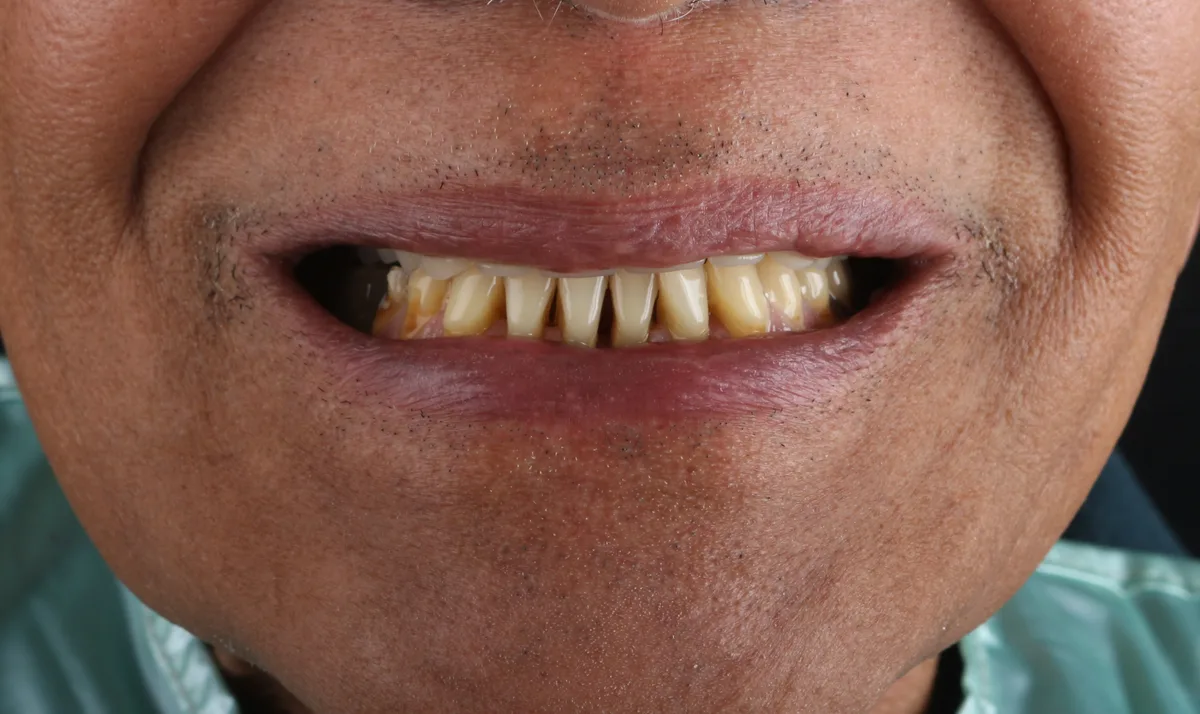 After — Full Arch Implant Prosthesis