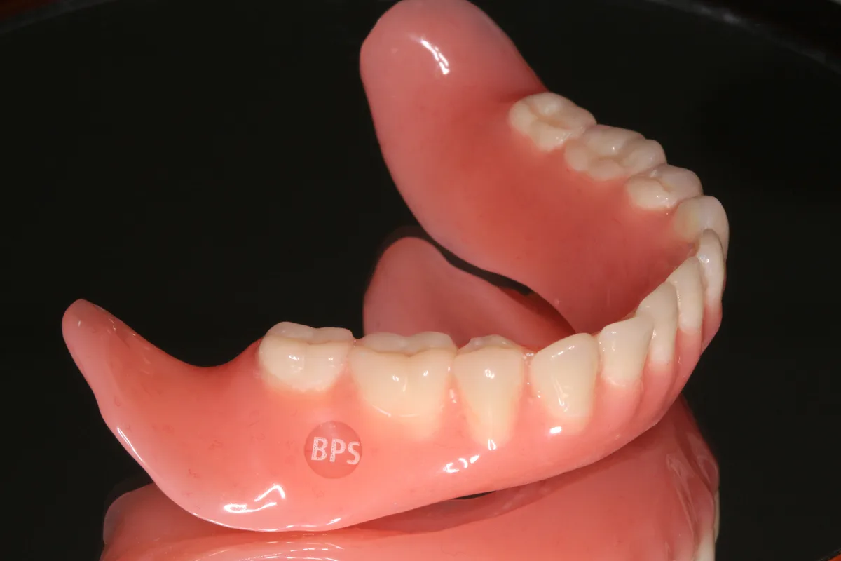 Implant Overdenture