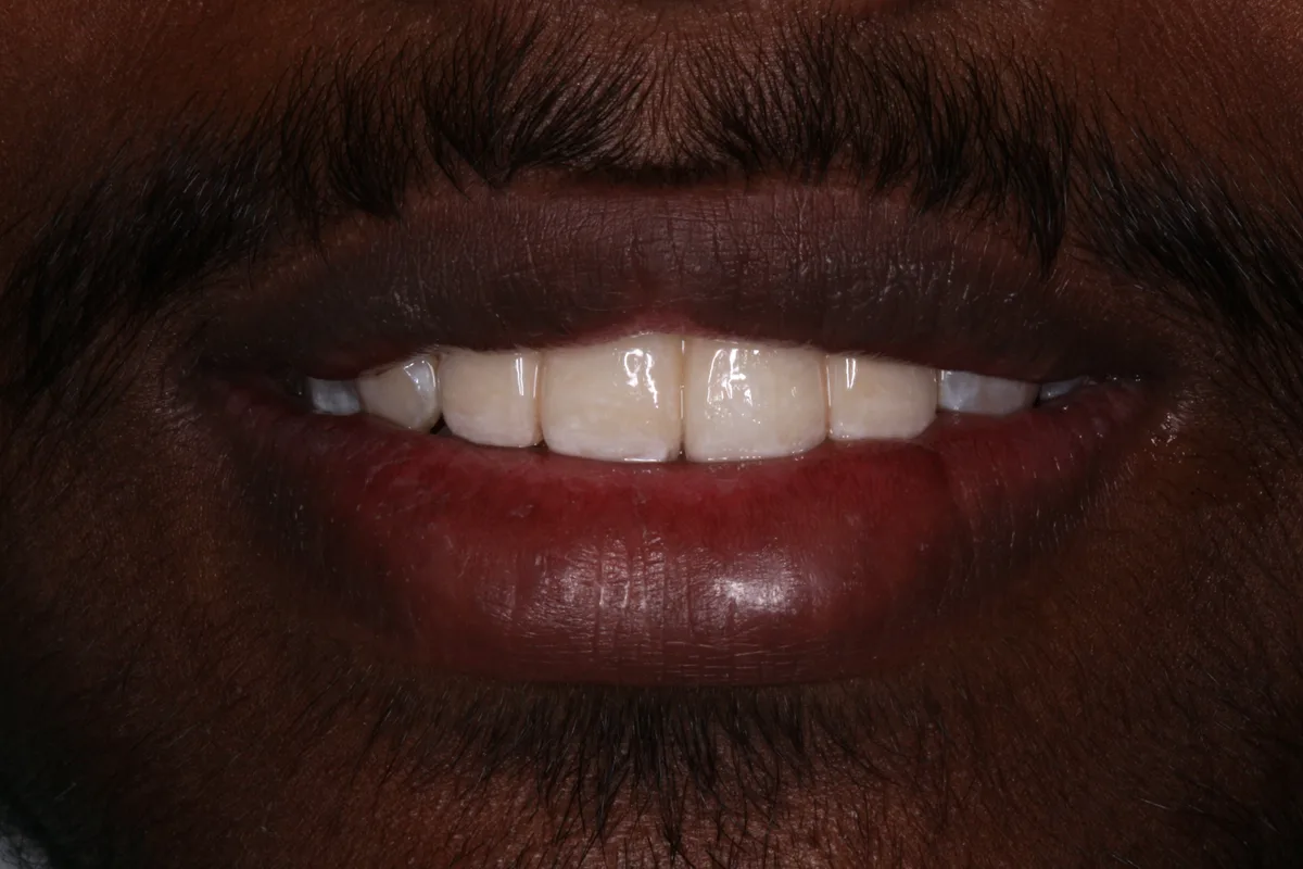 After — Multiple Tooth Implants