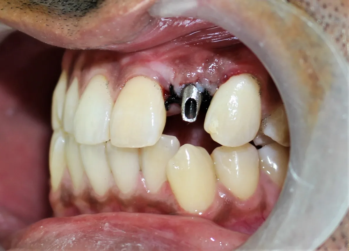 Single Tooth Implant