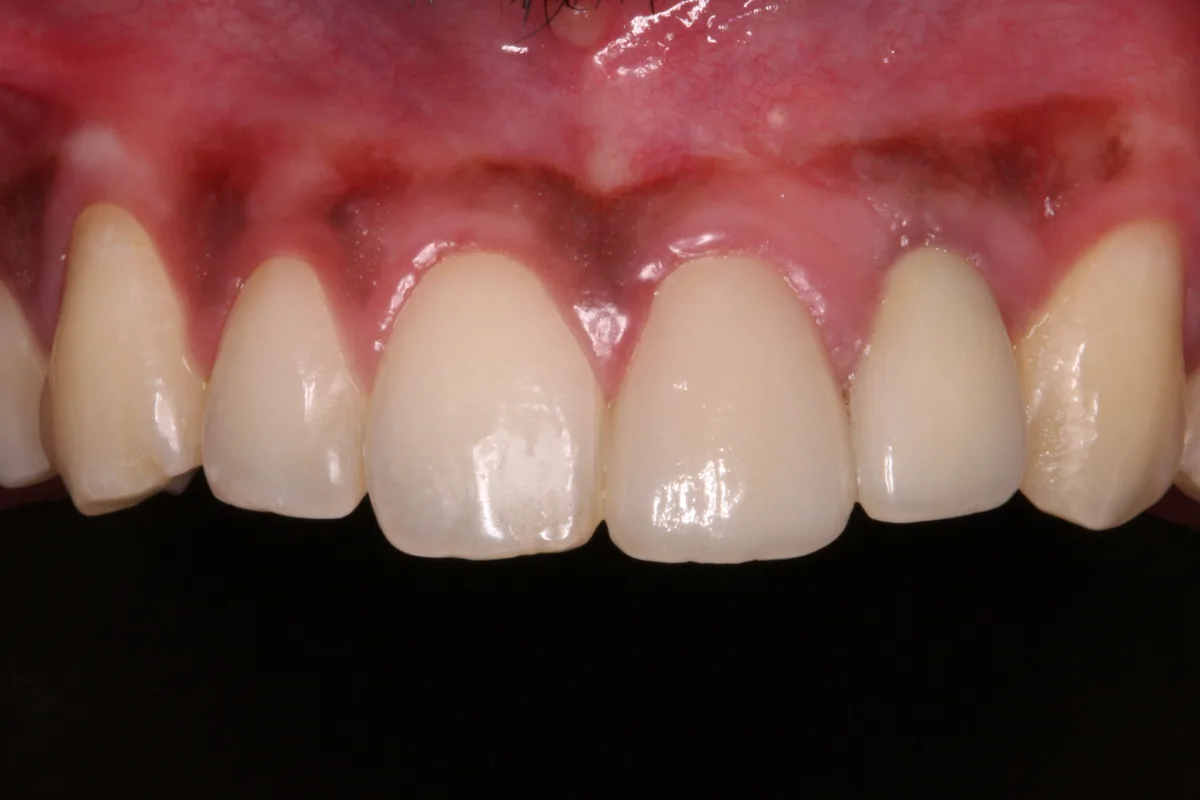 After — Single Tooth Implant