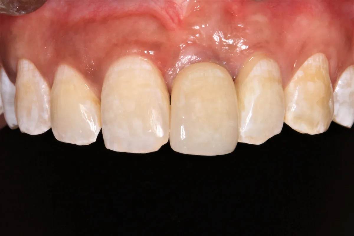 After — Single Tooth Implant