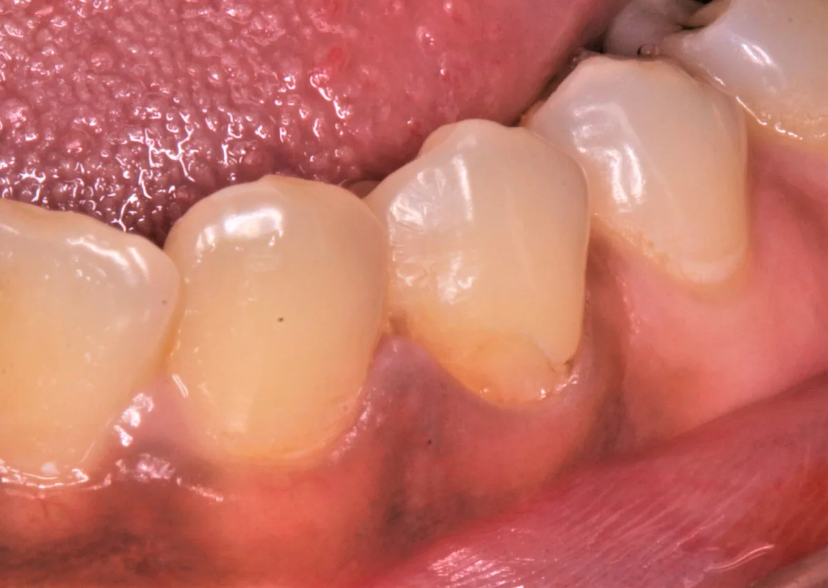Gingival Shaping for Filling