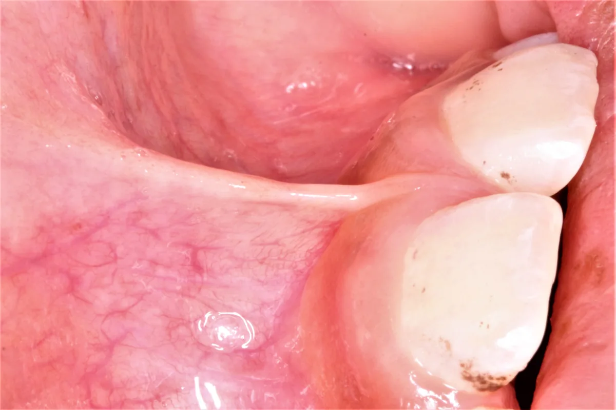 Laser Frenectomy