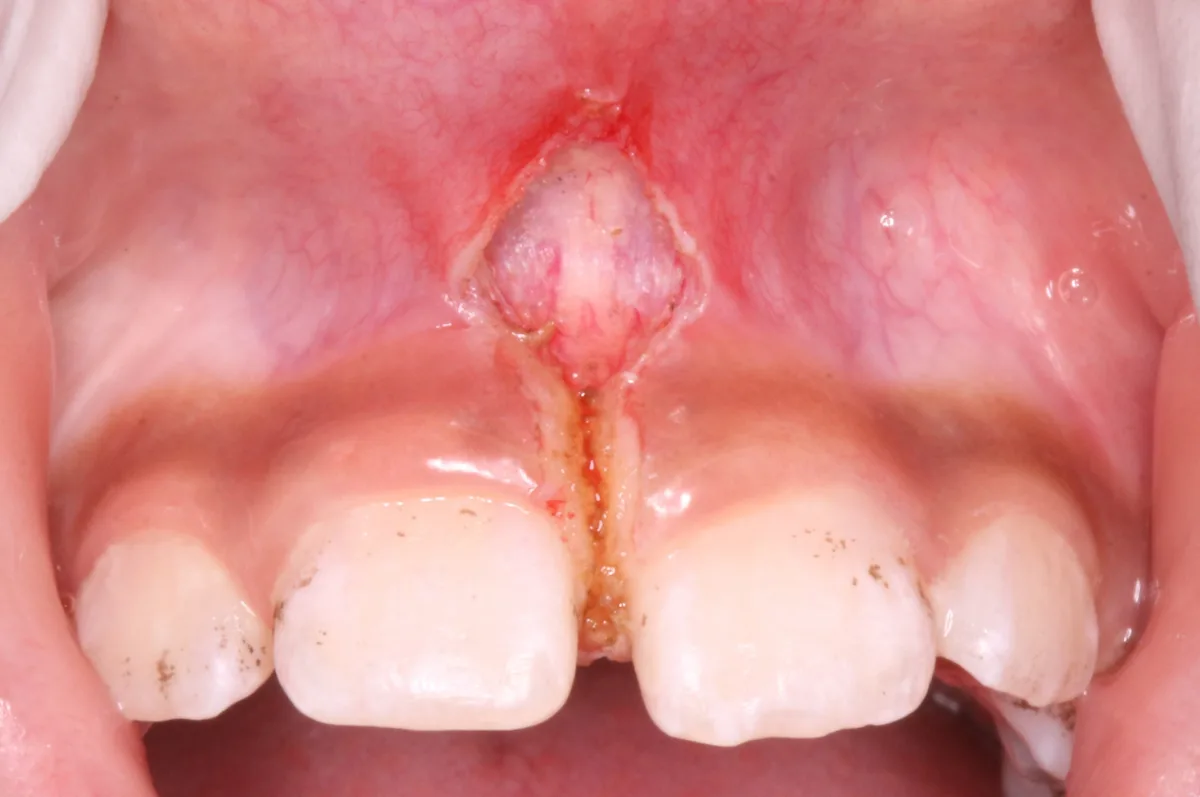 After — Laser Frenectomy