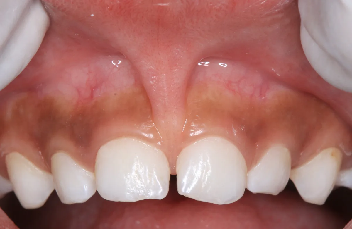 Laser Frenectomy