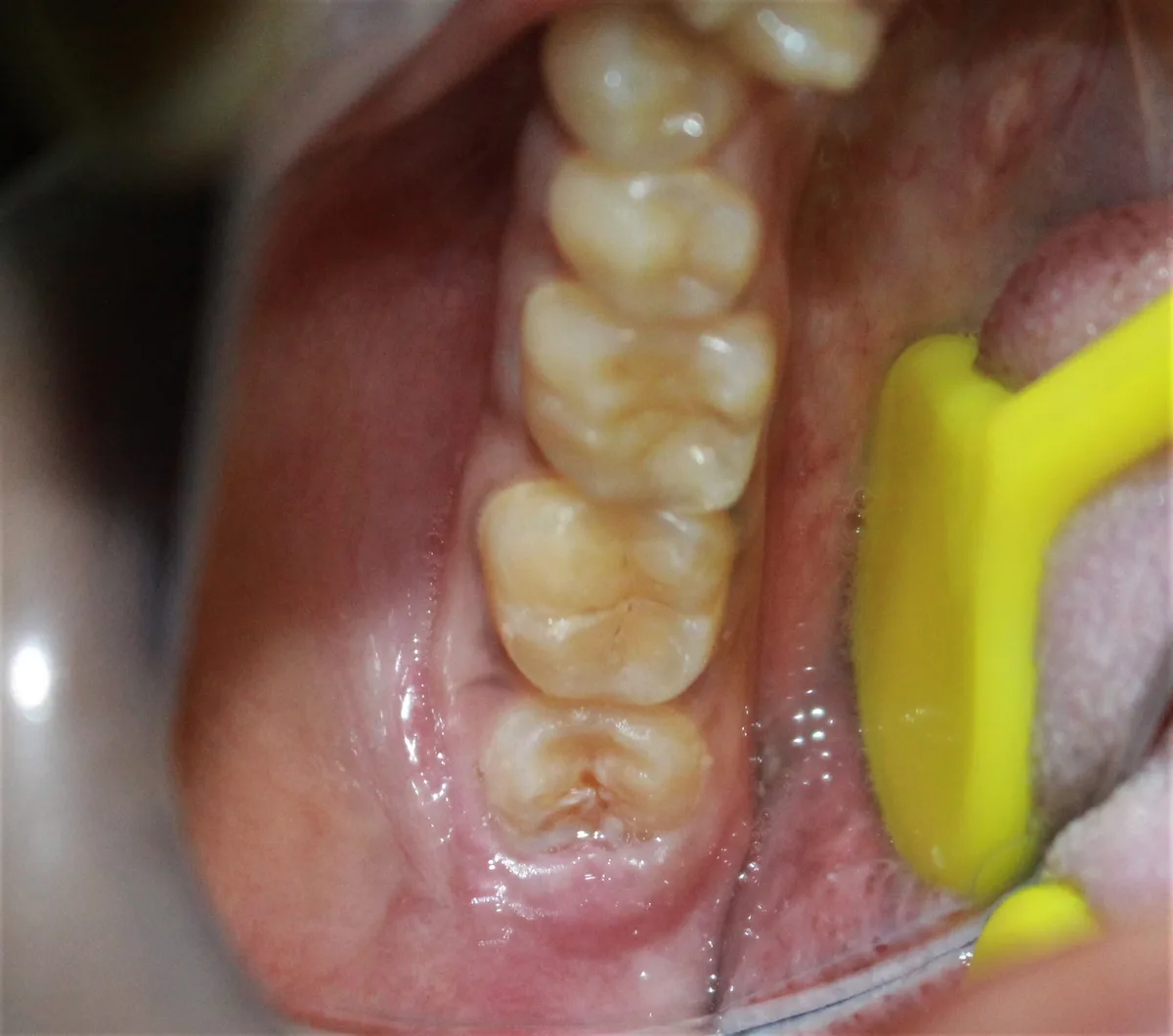Laser Operculectomy