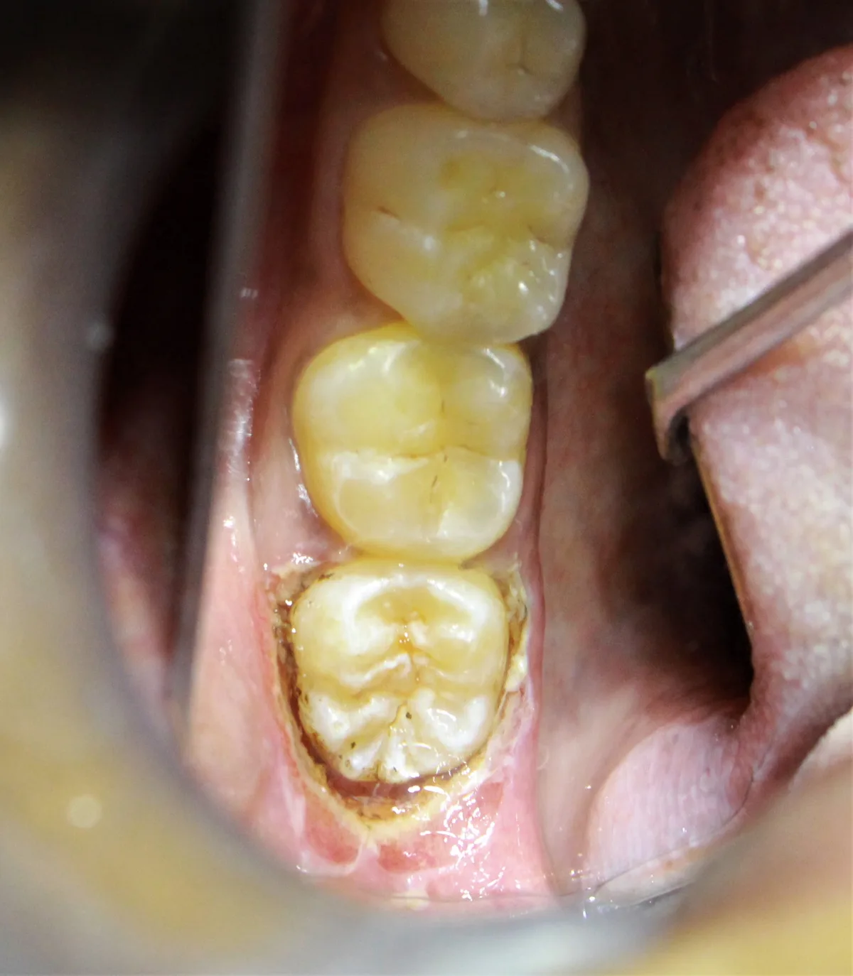 After — Laser Operculectomy