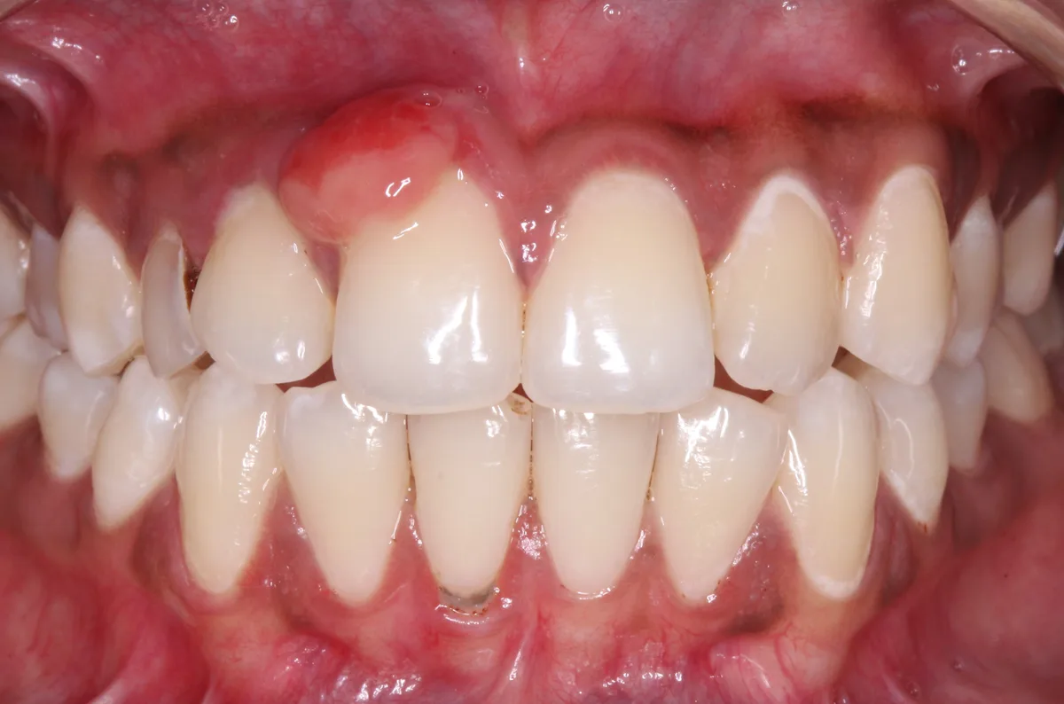 Pregnancy Gingival Hyperplasia
